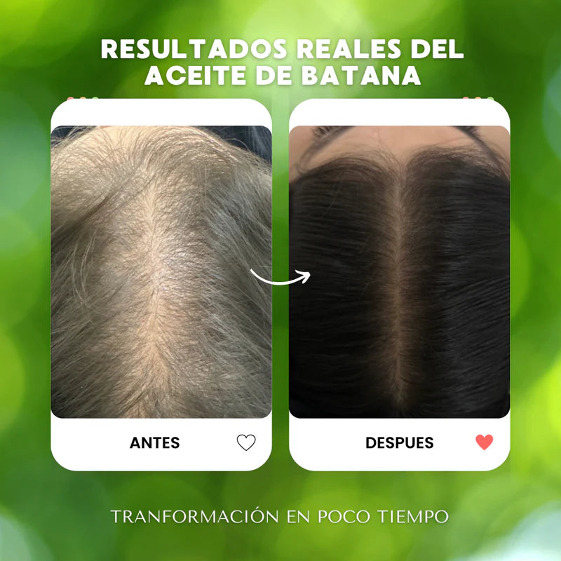 ACEITE DE BATANA RenovaHair™ – Solución Avanzada para la Caída del Cabello