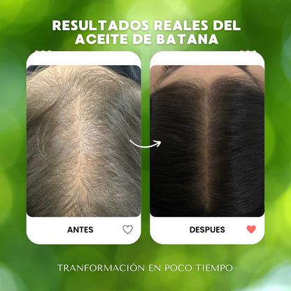 ACEITE DE BATANA RenovaHair™ – Solución Avanzada para la Caída del Cabello